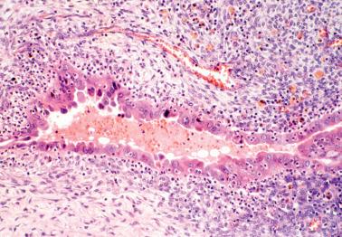 Fig. 19.21, Ovarian endometriotic cyst with reactive atypia of lining epithelial cells. The cells have eosinophilic cytoplasm and atypical nuclei.