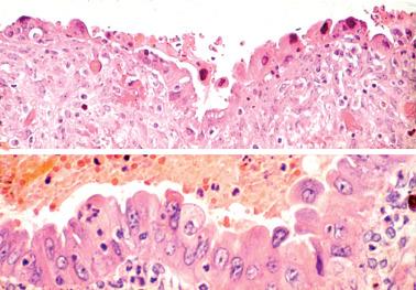 Fig. 19.22, Ovarian endometriotic cyst with reactive atypia of lining epithelial cells. Upper: A higher-power view of a field similar to that seen in Fig. 19.21 . The nuclear features are quite variable, with many having hyperchromatic nuclei with smudged chromatin. Lower: A different endometriotic cyst showing a more hyperplastic appearance of the lining epithelial cells that exhibit uniform atypia and prominent nucleoli.