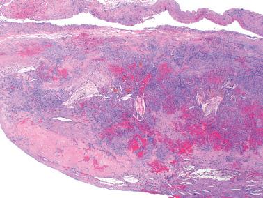 Fig. 19.23, Ovarian endometriotic cyst. This example, presumptively of long duration, contains numerous cholesterol clefts in the wall.