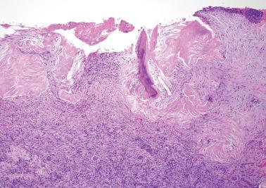 Fig. 19.24, Ovarian endometriotic cyst. This example, presumptively of long duration, shows ossification of the wall.