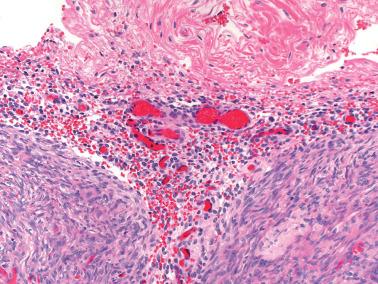 Fig. 19.26, Endometriosis involving the ovarian surface. Only the stromal component of the disorder is seen. Note the typical stromal cells and blood vessels.