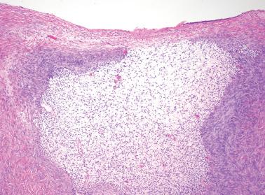 Fig. 19.27, Endometriosis involving the ovary. The stromal cells are more separated than usual in parting a loose edematous appearance.