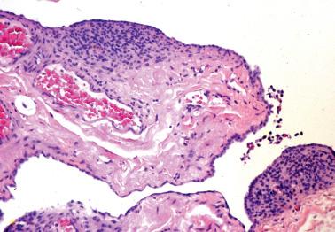 Fig. 19.28, Stromal endometriosis. A peritoneal biopsy specimen contains two submesothelial nodules of endometriotic stroma.