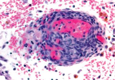 Fig. 19.29, Stromal endometriosis. A nodule of endometriotic stromal cells contains dilated capillaries. Extravasated erythrocytes and pigmented histiocytes are also seen.