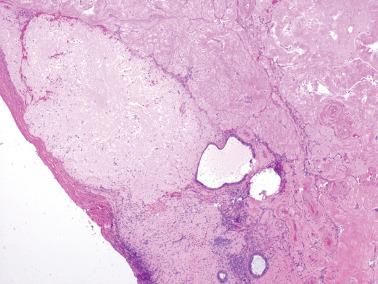 Fig. 19.30, Endometriosis with prominent elastosis involving the ovary. The elastosis contrasts with the adjacent corpus albicantia. Several endometrioid glands are seen.