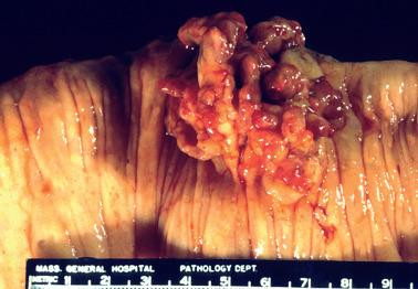 Fig. 19.3, Polypoid endometriosis of colon. A polypoid mass projects into the lumen of the colon, an appearance potentially mimicking a colonic adenocarcinoma.