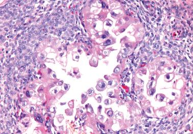 Fig. 19.31, Endometriosis in pregnancy showing Arias-Stella reaction.