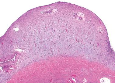 Fig. 19.32, Ovarian endometriotic cyst from a pregnant patient. The stroma is expanded and shows marked decidual change.