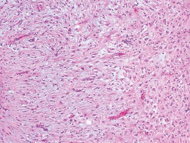 Fig. 19.33, Ovarian endometriotic cyst from a pregnant patient. The decidualized cells are focally spindled.