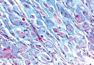 Fig. 19.34, Endometriosis in pregnancy. Decidualized endometriotic stromal cells, some of which contain intracytoplasmic vacuoles, are separated by basophilic mucin.