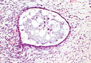 Fig. 19.35, Atrophic endometriosis. Periglandular endometriotic stroma is evident on the left. The rest of the stroma consists of loose fibrous stroma with a non-specific appearance.