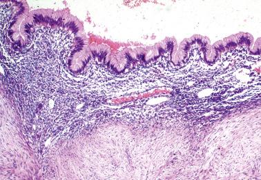 Fig. 19.36, Endometriotic cyst with mucinous metaplasia of its lining.