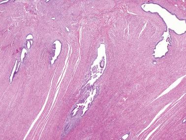 Fig. 19.37, Endometriosis involving the bowel wall.