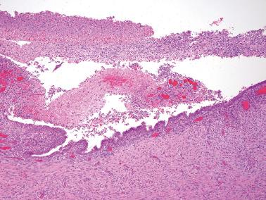 Fig. 19.38, Ovarian endometriotic cyst with superimposed infection. The endometriotic cyst (lower half) contains an inflammatory exudate.