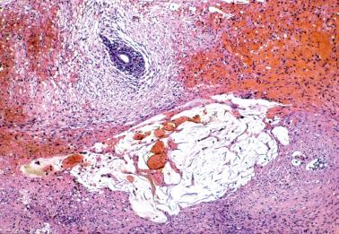 Fig. 19.39, Endometriosis with prominent myxoid stroma. A typical endometriotic gland with periglandular stroma is also present (upper left). This lesion was misdiagnosed as pseudomyxoma peritonei on frozen-section examination.