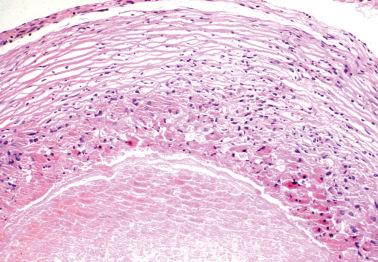 Fig. 19.40, Necrotic pseudoxanthomatous nodule of endometriosis. A central area of necrosis (bottom) is surrounded by pseudoxanthoma cells which in turn are surrounded by fibrous tissue.