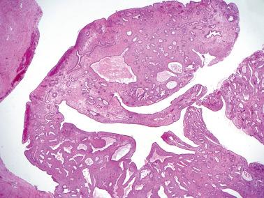 Fig. 19.42, Polypoid endometriosis forming a peri-ureteral mass. The stroma is fibrotic and results in an overall resemblance to an endometrial polyp.