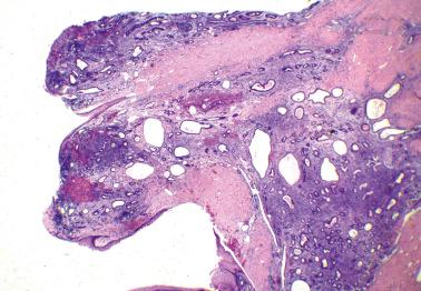 Fig. 19.43, Polypoid endometriosis of vagina. Polypoid masses of endometriosis (left) are partly covered by squamous epithelium. The polypoid component merged with underlying mural endometriosis (right).