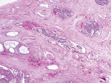 Fig. 19.44, Vascular involvement by endometriosis.