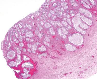 Fig. 19.45, Endometriosis with atypical hyperplasia. This focus was adjacent to an endometrioid adenocarcinoma.