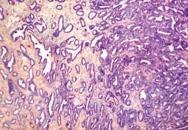 Fig. 19.46, Atypical hyperplasia (left) and grade 1 endometrioid adenocarcinoma (right) arising in pelvic endometriosis. The patient had been on unopposed estrogen therapy for 10 years.