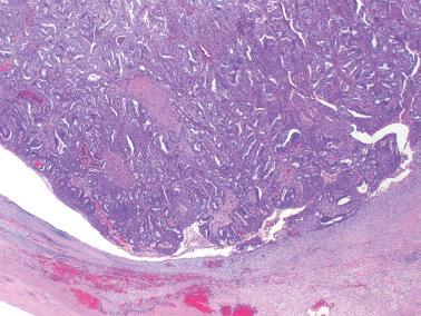 Fig. 19.47, Endometrioid adenocarcinoma arising in an endometriotic cyst. The tumor forms a large intracystic mass.