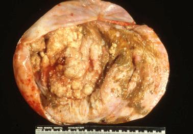 Fig. 19.48, Clear cell carcinoma arising in an endometriotic cyst. The tumor forms an irregular polypoid mass.