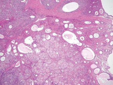 Fig. 19.49, Endometrioid carcinoma arising in polypoid endometriosis. This neoplasm was an inguinal mass. Note the cystic glands and fibrous stroma typical of polypoid endometriosis.