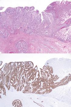 Fig. 19.50, Endometrioid adenocarcinoma arising in colonic endometriosis. Left: Residual endometriosis is seen at the top right. Right: A CK7 immunostain is strongly positive consistent with an endometrioid carcinoma and contrasts starkly with the adjacent colonic mucosa.