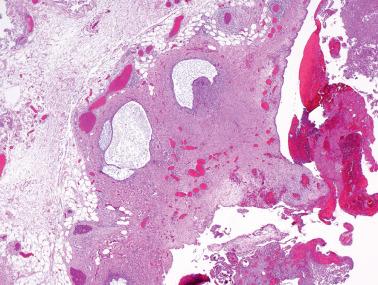 Fig. 19.5, Endometriosis involving the cul de sac.