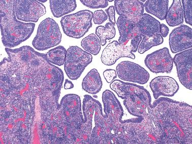 Fig. 19.51, Endometrioid cystadenoma of the pelvic soft tissue. The densely cellular stroma is common in this rare benign neoplasm. Conventional endometrial stroma was focally present.