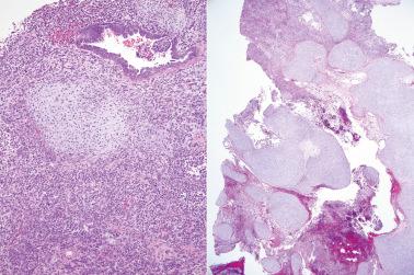 Fig. 19.52, Peritoneal malignant mixed müllerian tumor (MMMT)/carcinosarcoma. Left: Typical biphasic morphology with serous epithelium adjacent to primitive stroma with cartilaginous differentiation. Right: Foci of abundant cartilaginous differentiation were present.