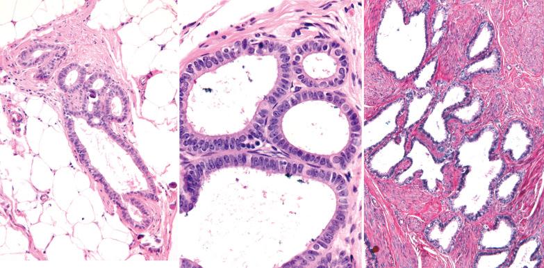 Fig. 19.53, Endosalpingiosis. Left: Tubal-type glands within omental fat. Center: The glands are lined by a single layer of bland columnar cells, some of which are ciliated. Right: Endosalpingiotic glands are present within myometrial smooth muscle.