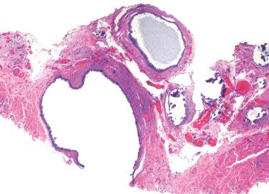 Fig. 19.54, Endosalpingiosis with focal calcification (right).