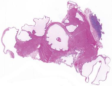 Fig. 19.55, Endosalpingiosis involving bowel wall.