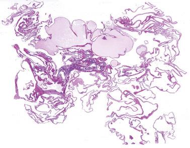 Fig. 19.56, Endosalpingiosis involving the peritoneum. This unusual manifestation of endosalpingiosis presented as a striking cystic peritoneal mass.