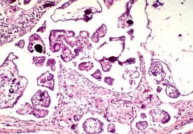 Fig. 19.57, Peritoneal serous borderline tumor.