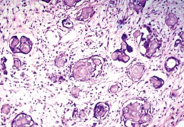 Fig. 19.58, Peritoneal serous borderline tumor. Numerous psammoma bodies, some surrounded by an inconspicuous rim of epithelial cells, are present.