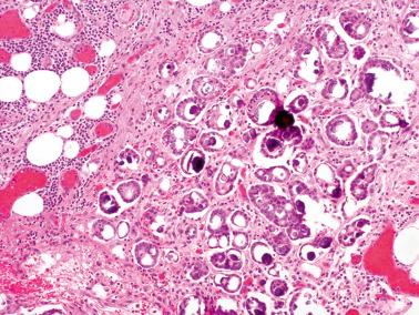 Fig. 19.59, Peritoneal low-grade serous carcinoma. There is an irregular arrangement of small clusters of serous cells with frequent lumens and focal calcification.