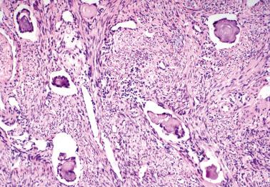 Fig. 19.60, Peritoneal low-grade serous carcinoma of ‘psammocarcinoma’ type. In contrast to peritoneal serous borderline tumors, the tumor was invasive. In this field the tumor involves myometrial lymphatics.