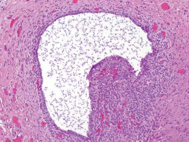 Fig. 19.6, Endometriosis involving the cul de sac. A high-power view of a gland seen in the prior illustration shows conspicuous endometrial stroma and typical capillaries.