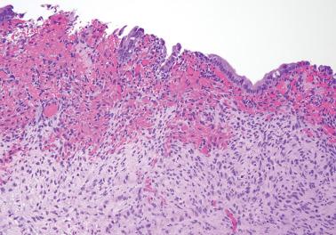 Fig. 19.7, Ovarian endometriotic cyst. Typical subepithelial hemorrhage with associated endometrial stromal cells that become more spindled and nonspecific in appearance distant from the cyst lining.