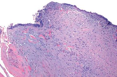 Fig. 19.8, Ovarian endometriotic cyst. The stellate mesenchymal cells with vaguely myxoid stroma represents a common finding in the stroma of endometriotic cysts.