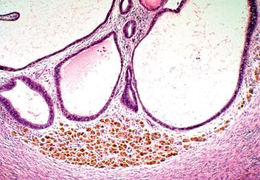 Fig. 19.9, Ovarian endometriosis. Endometriotic glands, stroma, and pigmented histiocytes are seen.