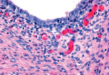 Fig. 19.10, Endometriosis. There is only a thin periglandular cuff of endometriotic stroma, which is highlighted by the presence of small capillaries. The stroma away from the gland is fibrotic.