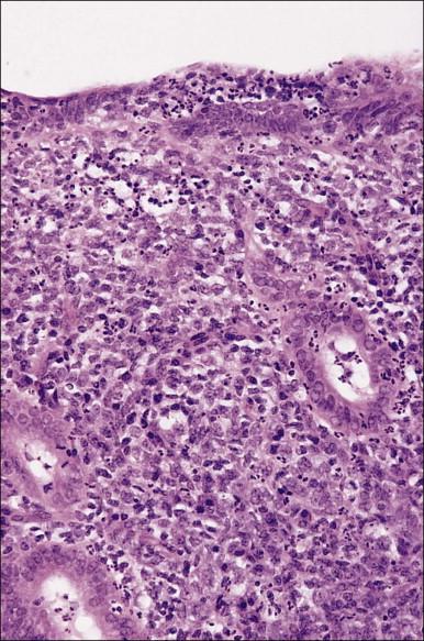 Figure 16.1, Acute endometritis. Polymorphs are present in the surface epithelium and throughout the stroma.