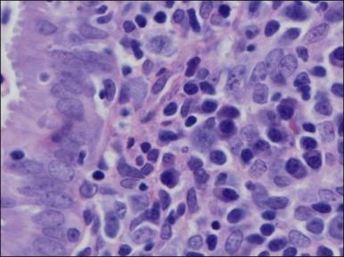 Figure 16.2, Chronic endometritis. Plasma cells are prominent in the stroma.