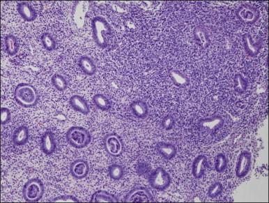 Figure 16.3, Chronic endometritis. At low magnification, the presence of a patchy infiltrate of inflammatory cells makes the stroma appear dirty.