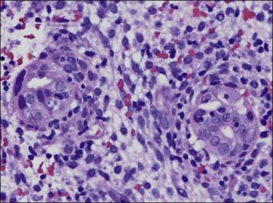 Figure 16.4, Cytomegalovirus infection. Cells with grossly enlarged nuclei are present in small glands.