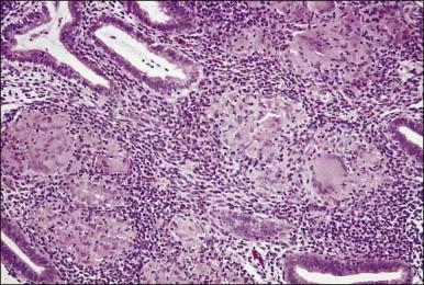 Figure 16.5, Tuberculous endometritis. Noncaseating granulomas are distributed throughout the stroma.